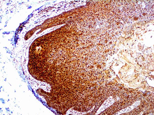 IHC of HIF-1 alpha on an FFPE Anal Carcinoma Tissue
